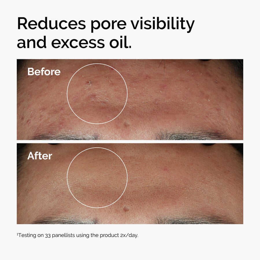 niacinamide-10-zinc-1-k0 ord-niacinamide-zinc-blemish-serum-before-after-pores.jpg