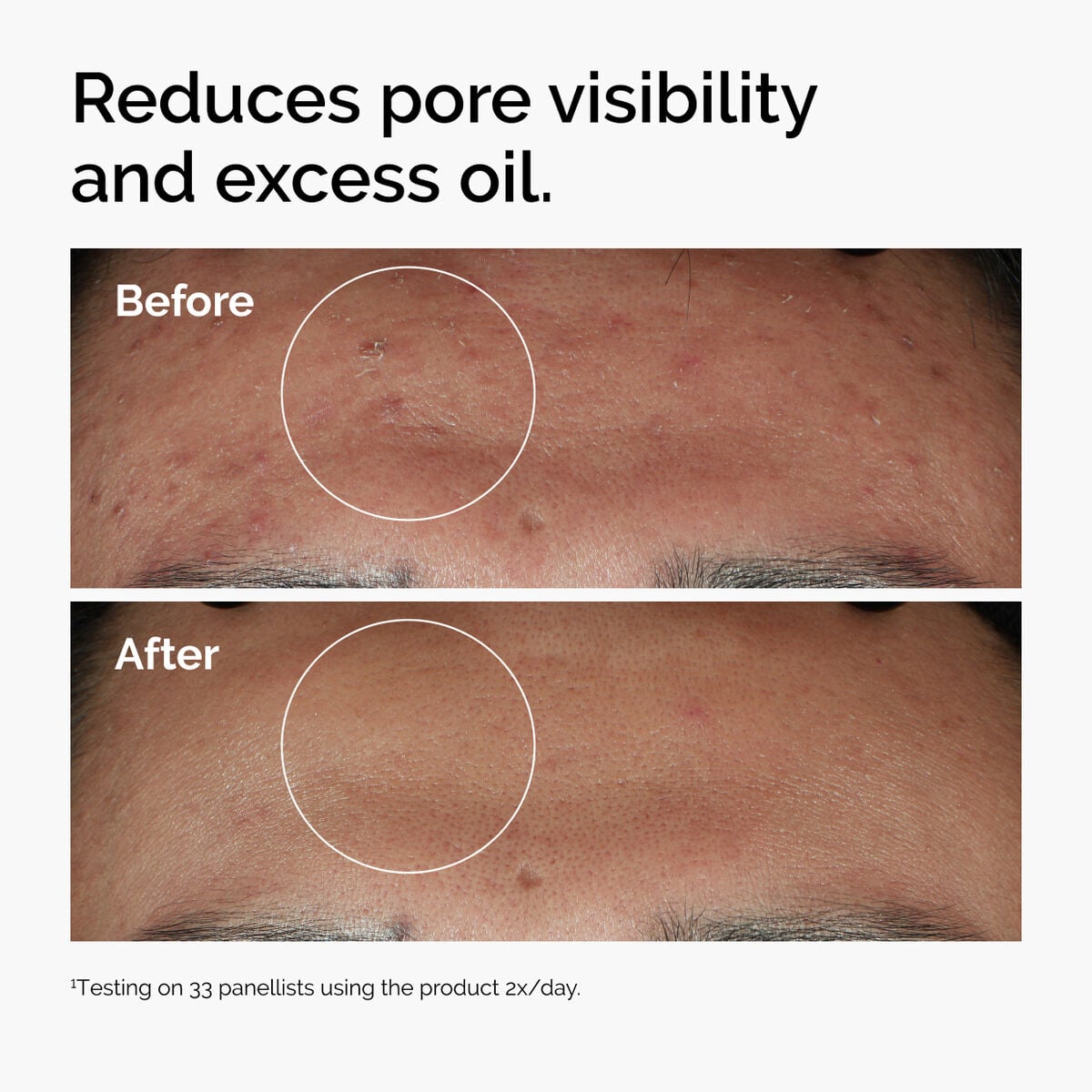 niacinamide-10-zinc-1-k0 ord-niacinamide-zinc-blemish-serum-before-after-pores.jpg