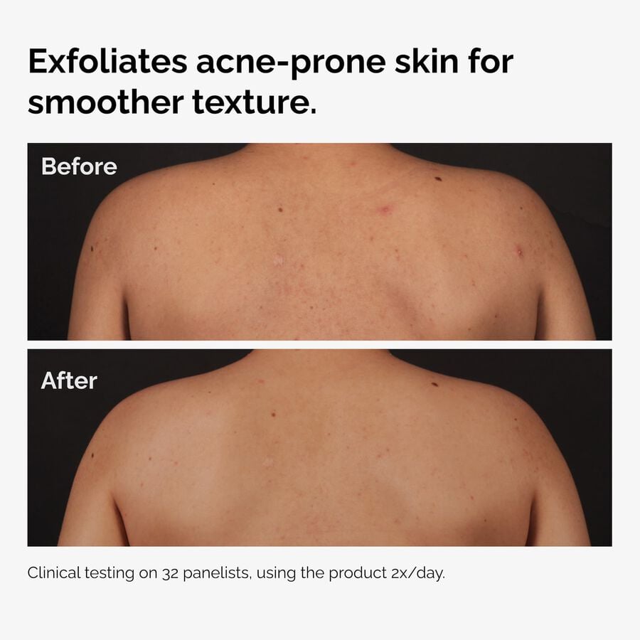 salicylic-acid-0-5-body-serum-d5 ord-salicylic-acid-body-serum-before-after-graphic-NA.jpg