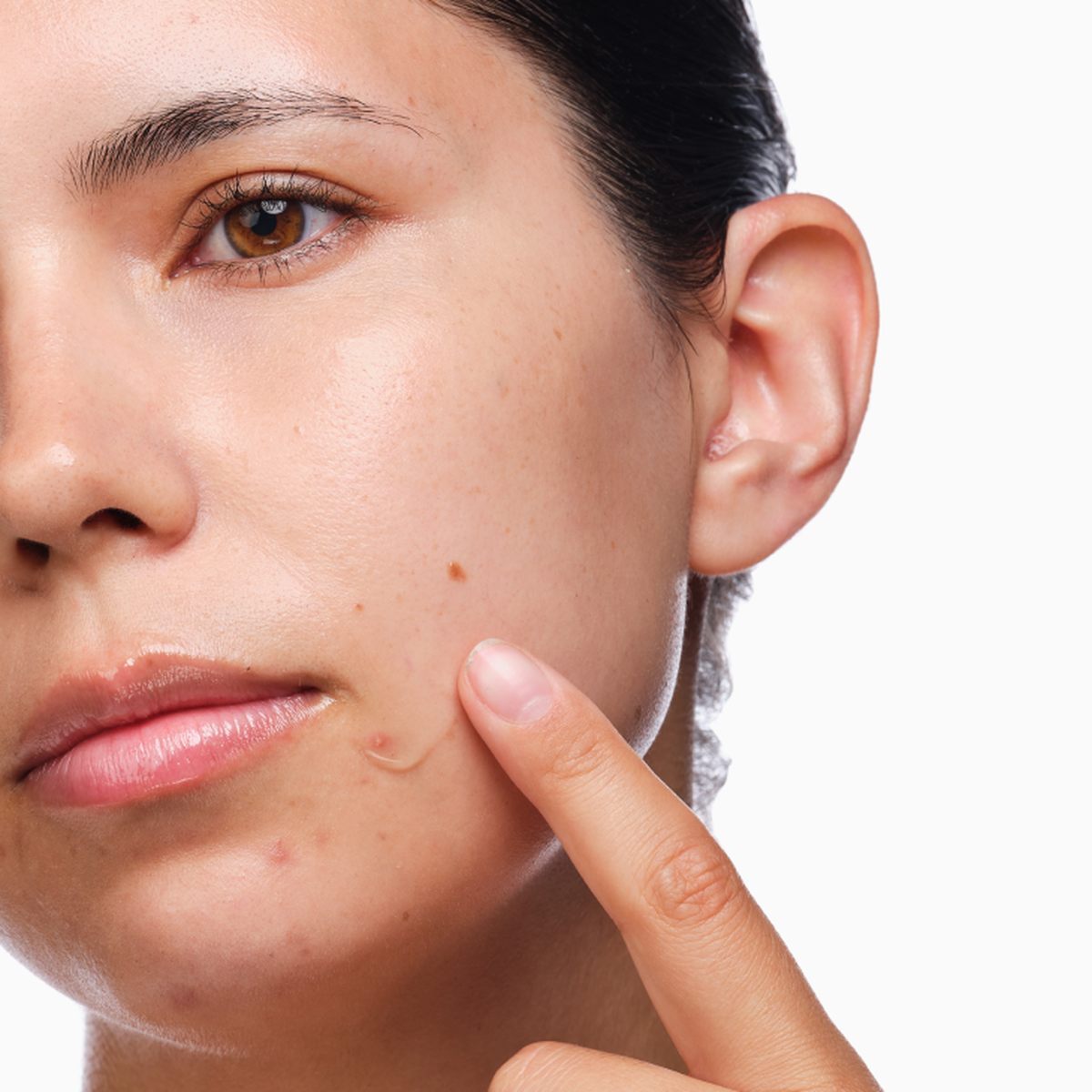 the-acne-set-p5 rdn-the-acne-set-application.png